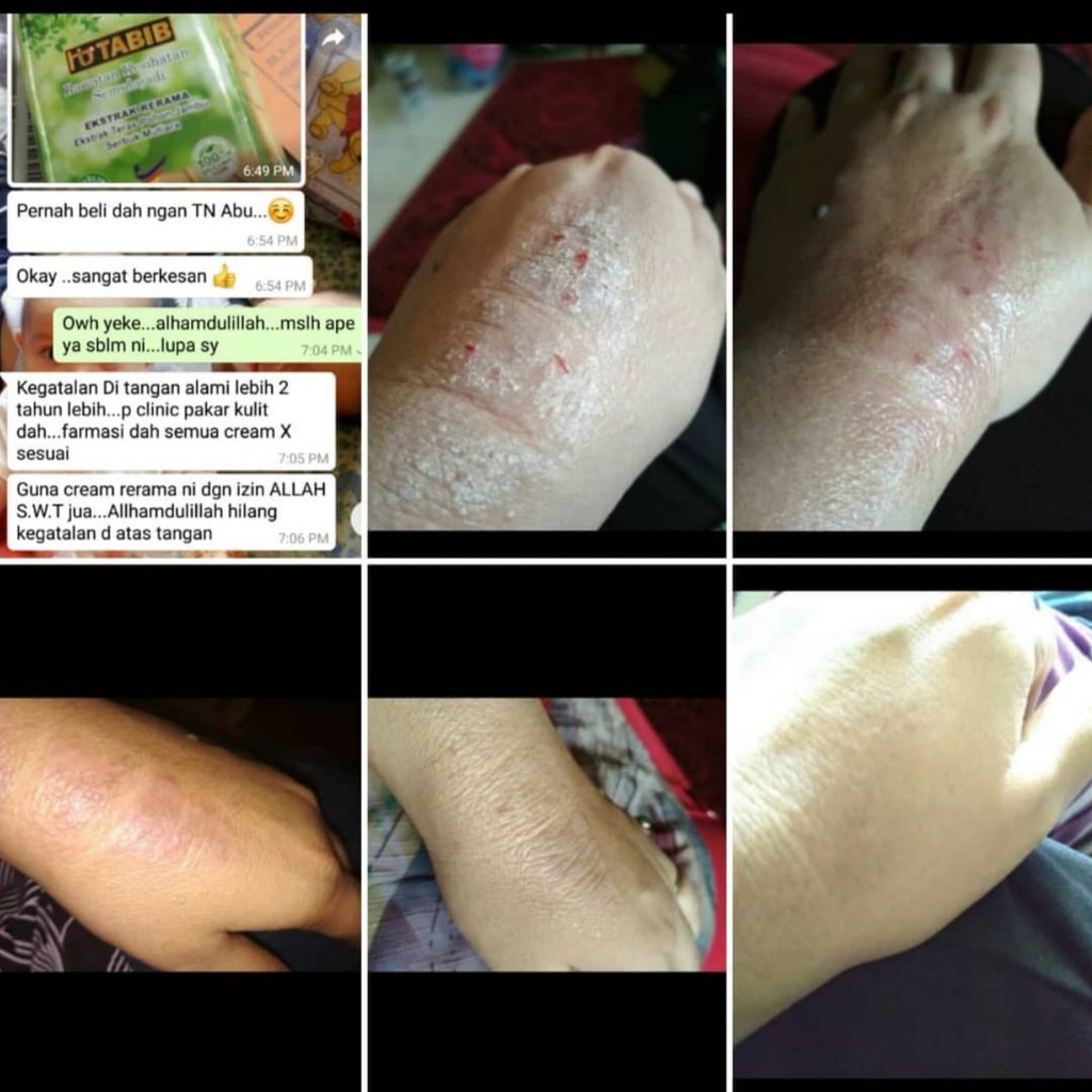 Ubat Gatal Kulit Krim Rerama Eczema Cream Hb Tabib Krim Gatal Kulit Original Hq Shopee Malaysia