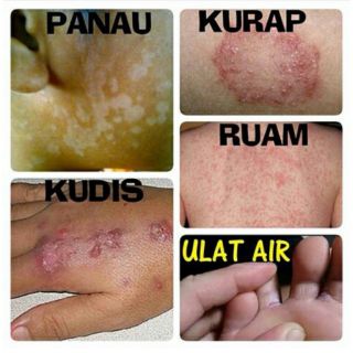 Krim Daun Gelenggang 20g panau, kudis, kurap, ruam dan 