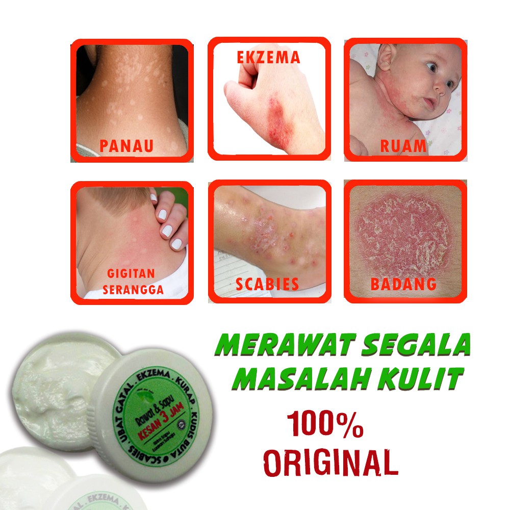 Ubat Gatal, Kudis, Ruam, Elergik, Kulat Air, Ekzema, Ubat Parut