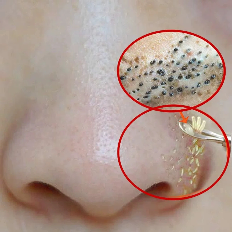 Rawatan Buang Blackhead Tips Rawatan