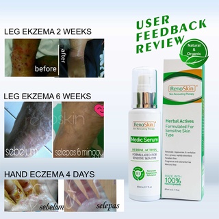 Ubat  Serum Ekzema, Psoriasis, Masalah Kulit sensitif, Lotion Eczema