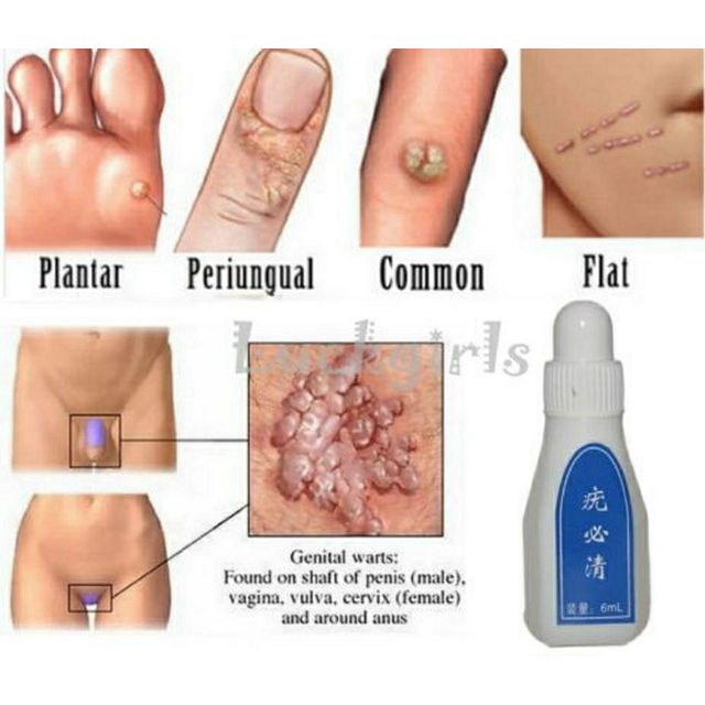 Ubat ketuat / remover skin tag mole genital wart plantar 