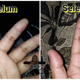 MINYAK herba ubat utk KULIT SENSITIF, ALERGIK, EKZEMA  MINYAK herba ubat utk KULIT SENSITIF, ALERGIK, EKZEMA