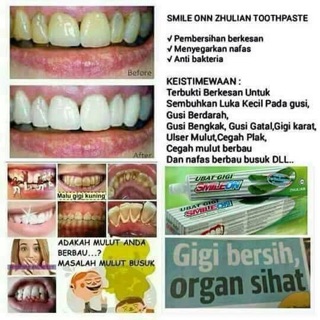 Ubat Gigi dan Cecair Kumur SMILE ON  Shopee Malaysia