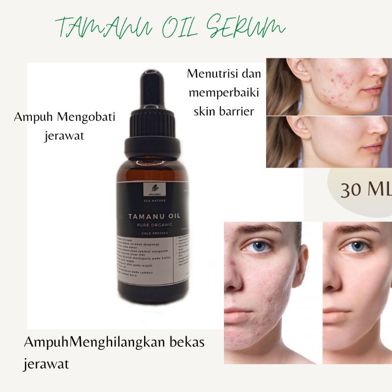 Tamanu OIL / FACE OIL / Acne Scar Removal Medicine / Acne Scar Removal (Bomarks) / stretchmarks