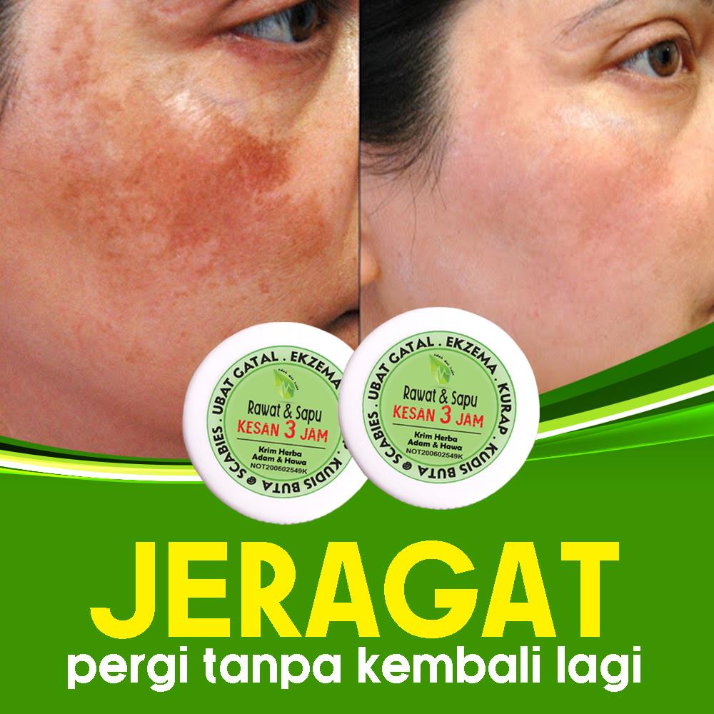 Krim Gatal Lulus Kkm Krim Gatal Bayi Krim Gatal Adam Hawa Ubat Gatal Kudis Kurap Enzema Panau Jerawat Shopee Malaysia