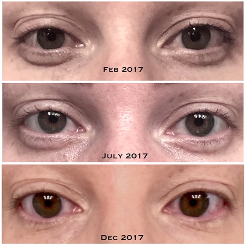 ordinary eye wrinkles