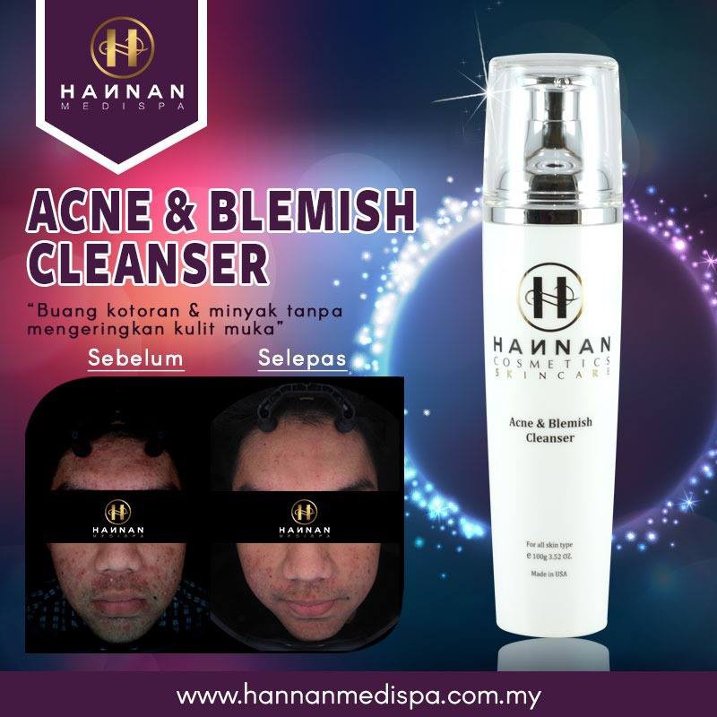 Acne Treatment Hannan Medispa Price