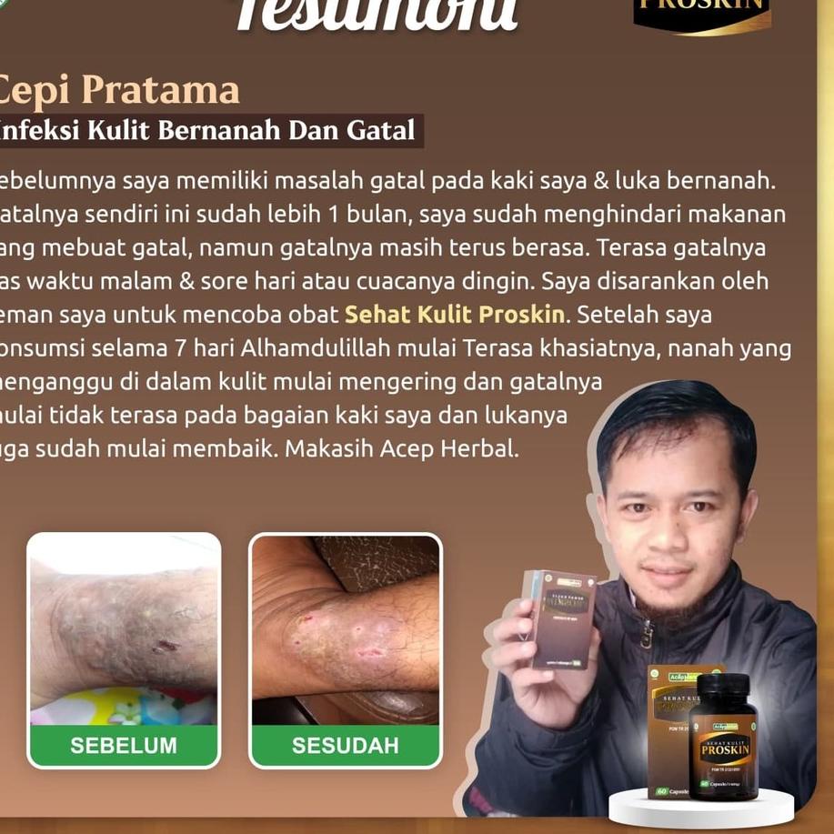 Best SellingSq26Proskin Itching Skin Medicine, Groin Itching