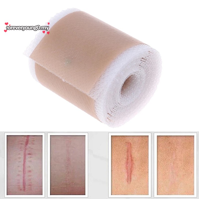 Efficient Beauty Scar Removal Silicone Gel Self-Adhesive Silicone Gel ...