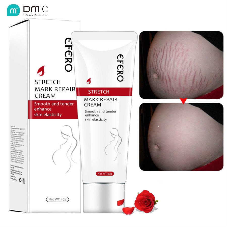 stretch marks cream dm