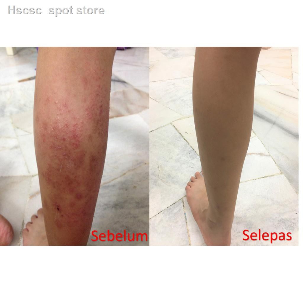 Ekzema Kulit Gatal Losen Ezi Moisturizing Lotion Ubat Ekzima Sensitif Allergik Alahan Melecur Bibir Kering Xukin K Shopee Malaysia