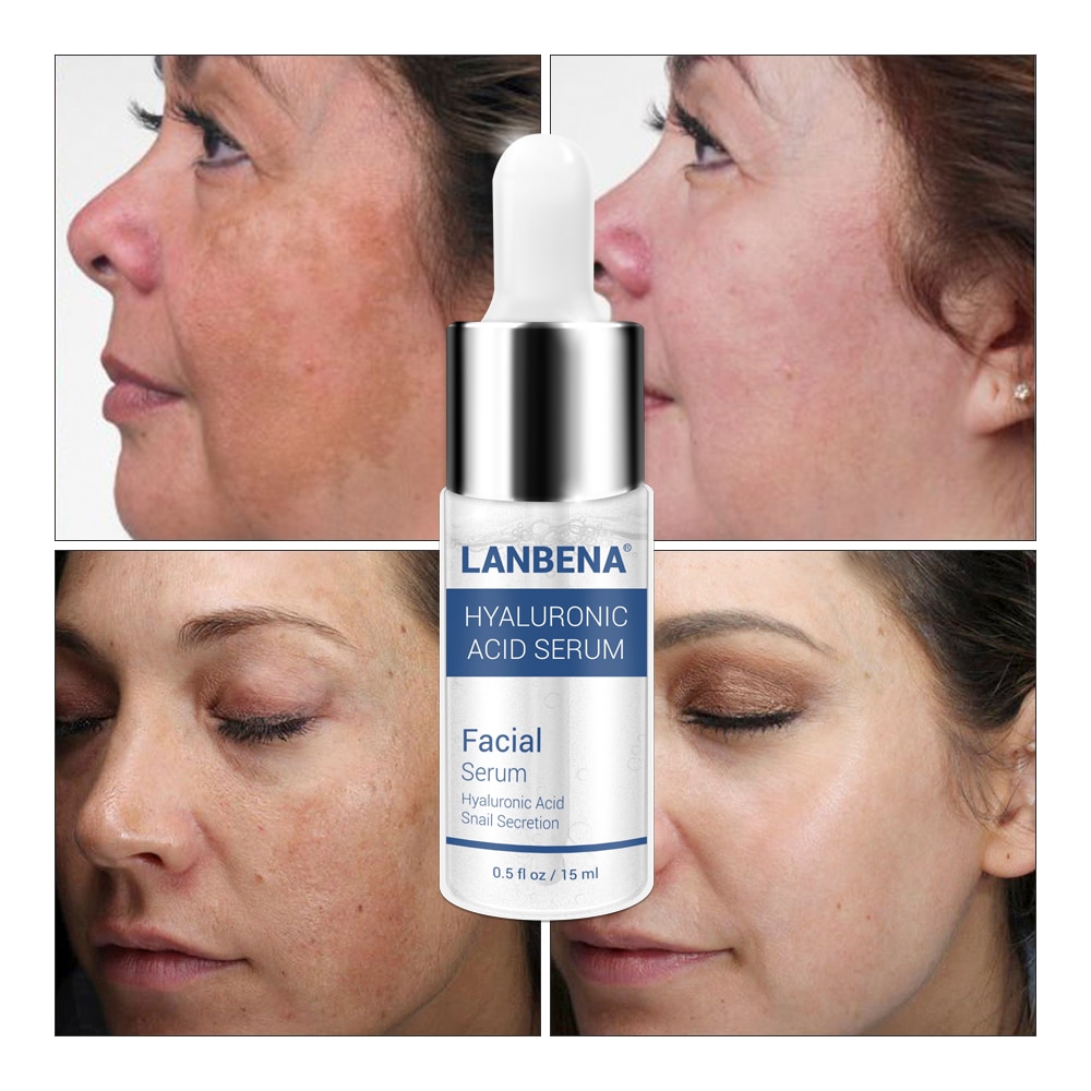 hyaluronic acid serum causing breakouts