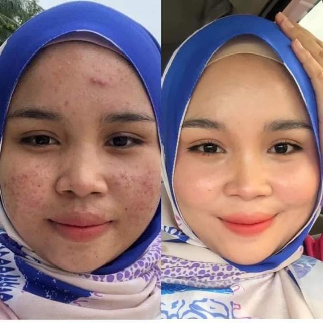 Buy Nb Scar Acne Therapy Cream Seetracker Malaysia
