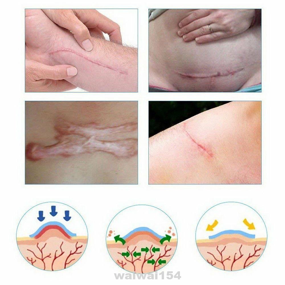 silicone gel pads for scars