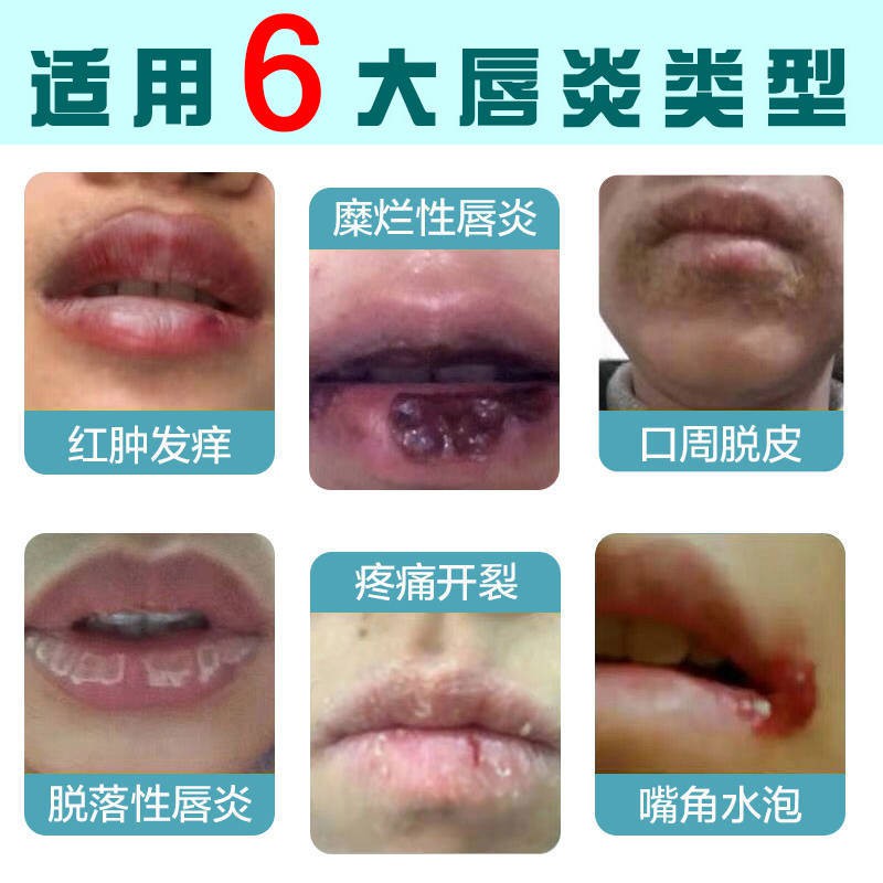 Lip Balm For Cheilitis Cream唇炎膏专用唇膏润唇膏过敏性唇周炎嘴唇干裂口角红痒保湿修复唇膏 Shopee Malaysia