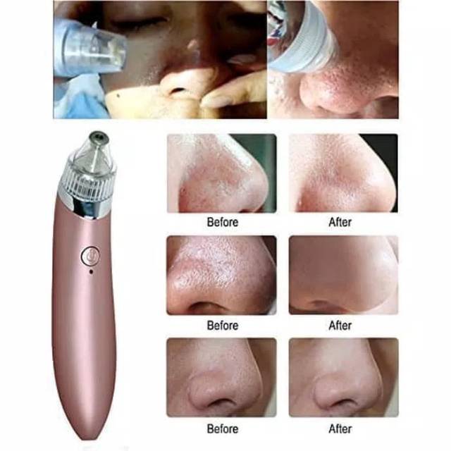 BEAUTY SKIN CARE CW 666 BLACKHEAD AND ACNE SUCTION TOOL