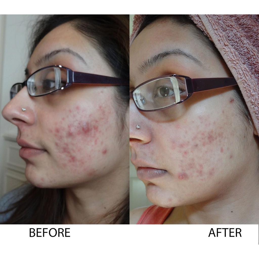 cetaphil oily skin cleanser before and after