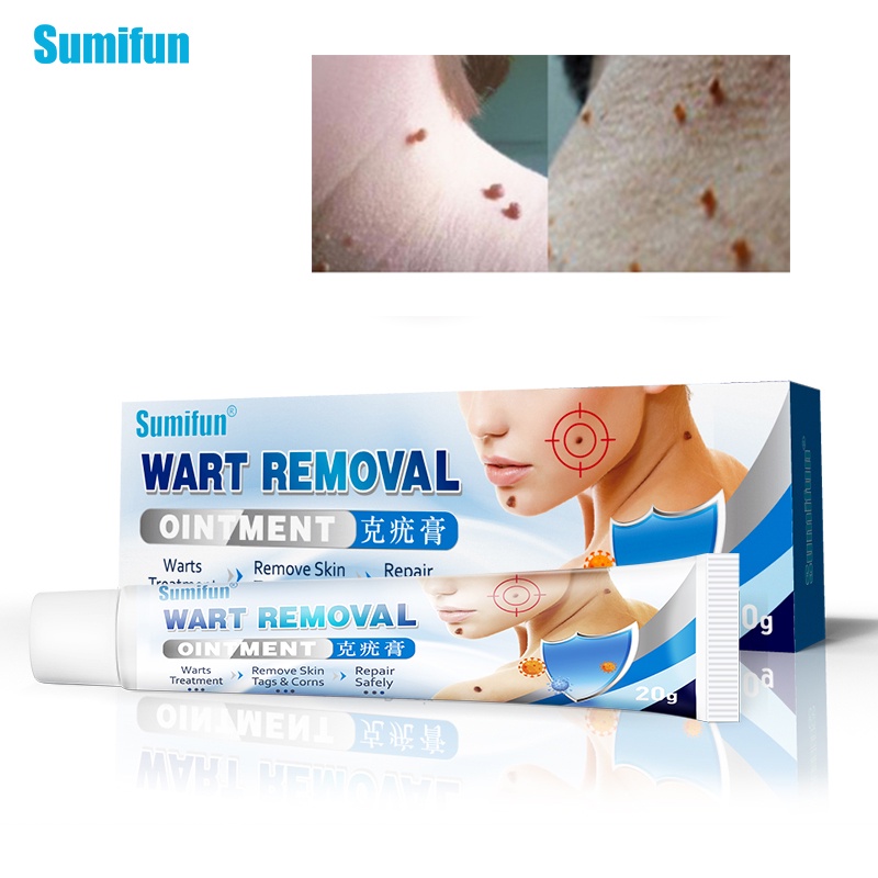 Qian Skin Tag Remover Cream Against Moles Fast Removal Genital Wart Acne Spot Treatment Anti 1647
