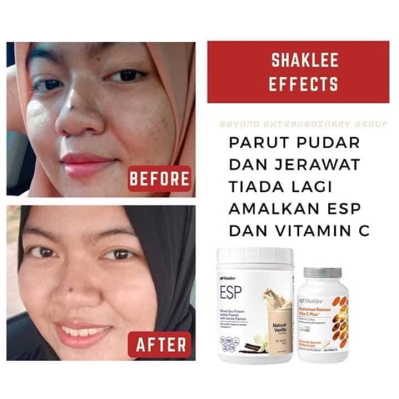 𝗦𝗘𝗧 𝗖𝗔𝗡𝗧𝗜𝗞 𝗕𝗔𝗦𝗜𝗖 𝗦𝗛𝗔𝗞𝗟𝗘𝗘 Esp Vitamin C Shaklee Cerah Jerawat Imunisasi Slimming Sembuh Luka Parut Youth Shopee Malaysia