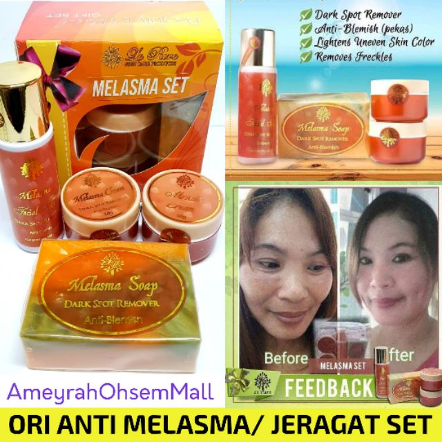 miracle cream for melasma