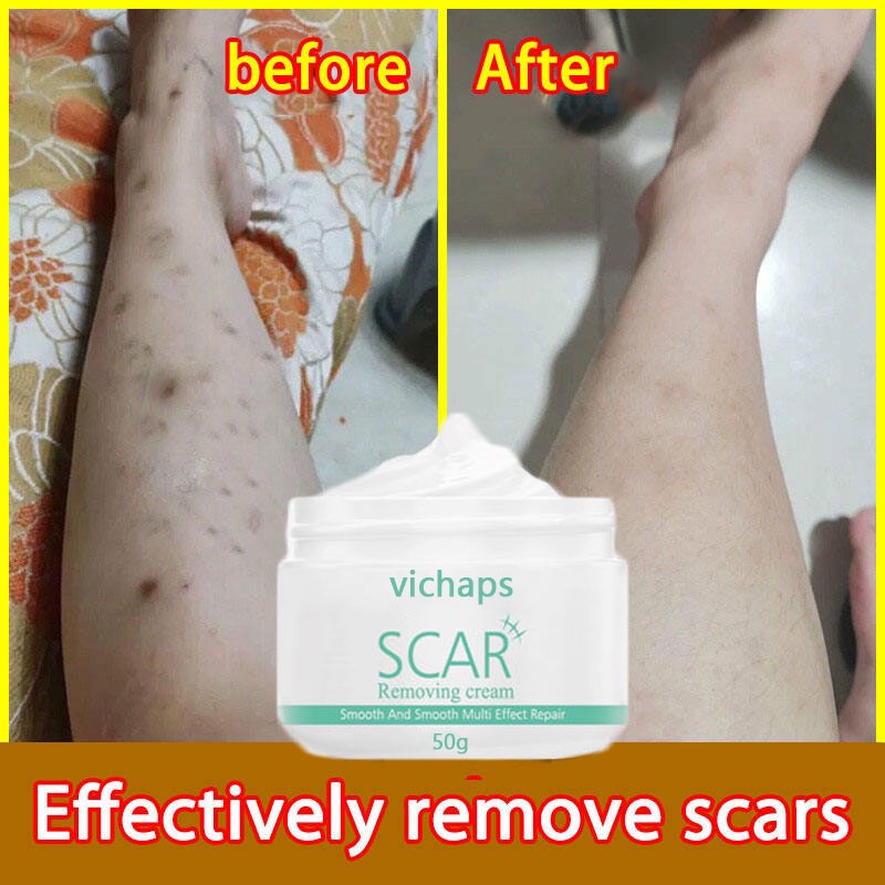 Scar Remover for Old Scar on Leg Stretch Mark Remover Acne Scar Remover