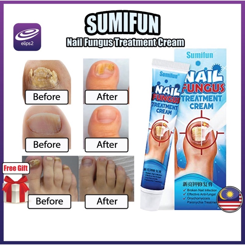 Kulat kuku Nail fungus treatment cream Sumifun Nail Fungus Onikomikosis ...