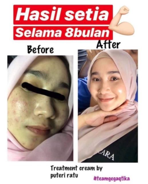 Original By Hq Puteri Ratu Treatment Cream Shopee Malaysia