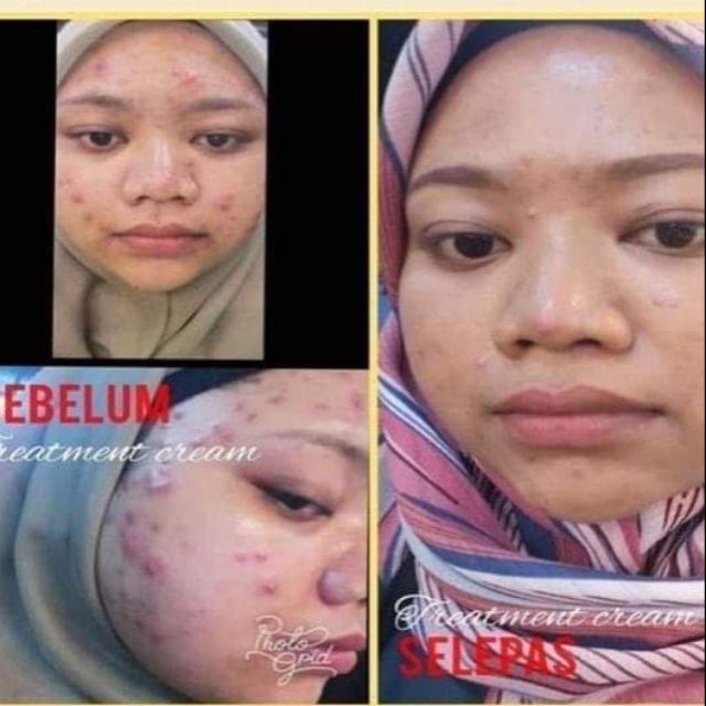 Krim Hilangkan Jeragat Jerawat Parut Shopee Malaysia