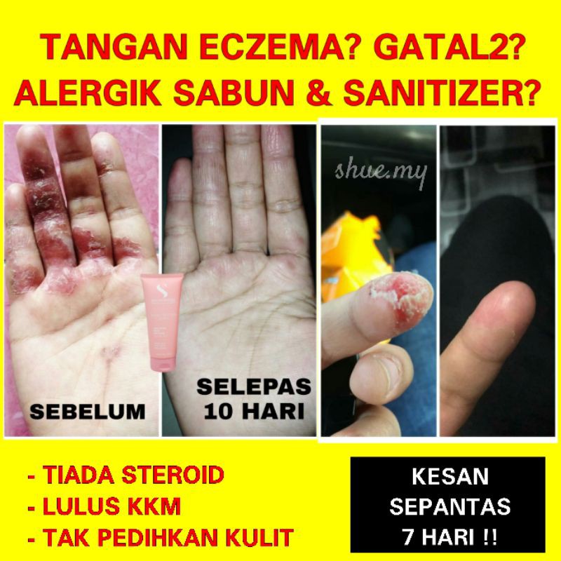 Lotion Rawat Tangan Kaki Eczema Kulat Air Gatal Alergik Sabun Hand Sanitizer Shopee Malaysia