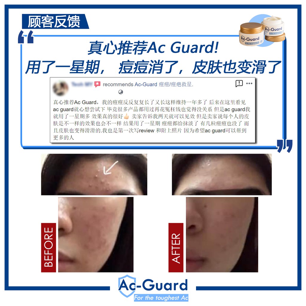 ac guard acne