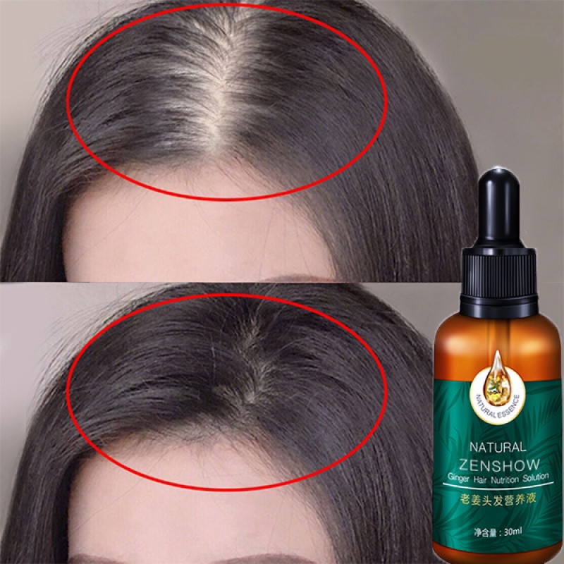 Hair Growth Essence Ginger Anti Hair Fall Serum Hair Loss Essence Hair Loss  tonic Care Essential 30ml 生发精华液 防脱发 生发 老姜生发 | Shopee Malaysia