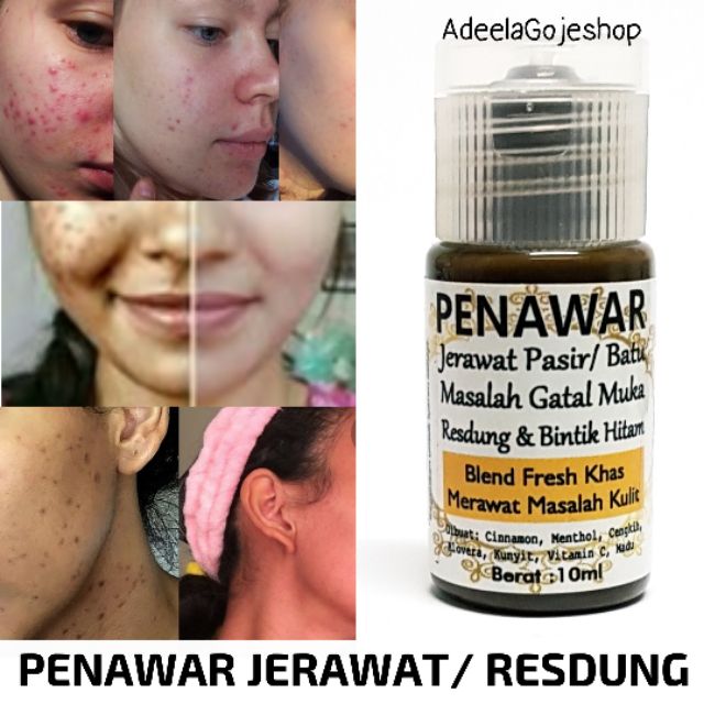 Penawar Jerawat Resdung Gatal Muka Bantu Masalah Kulit Shopee Malaysia