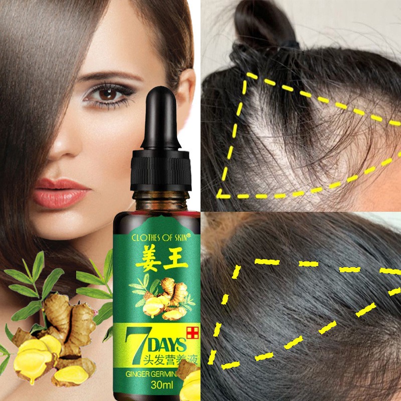 30ML Ginger King Essential Oil Hair Growth Serum Anti-Hair Loss Prevent Hair  Fall Hair Care Hair Regrowth Treatment | Shopee Malaysia