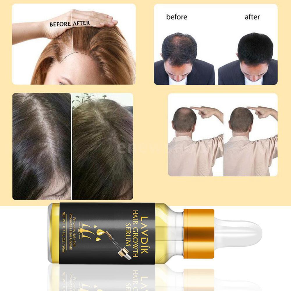 LAVDIK Hair Growth Serum Hair Loss Treatment Prevention Liquid for Hair  Regrowth Thicker Longer Stro | Shopee Malaysia