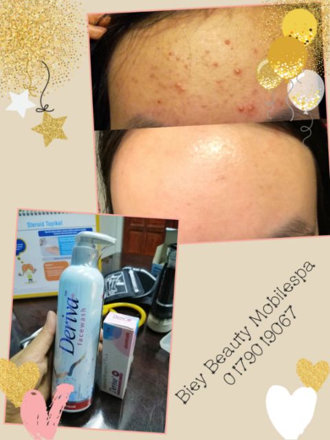 Deriva Face Wash Salicyclic Acid 1 5 Shopee Malaysia