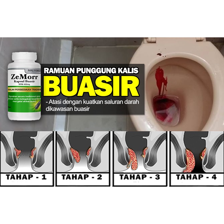 Free Postage Kapsul Zemorr Merawat Buasir Hemorrhoid Sembelit Lulus Kkm Shopee Malaysia