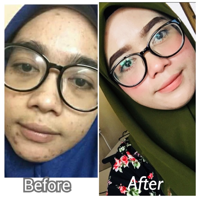 Krim pakistan Ubat terbaik utk mslh jeragat jerawat degil 