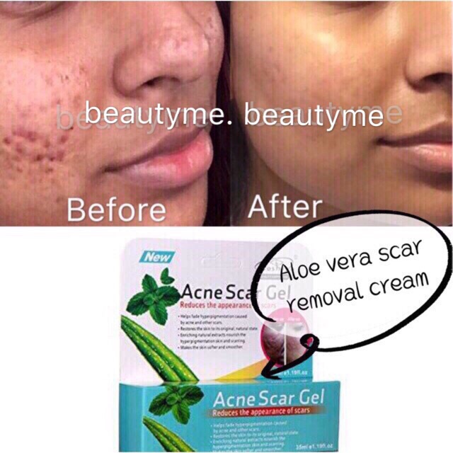 Buy Ready Stock 35ml Acne Scar Gel Scar Treatment Acne Pimple Removal Gel Krim Anti Jeragat Dan Parut Seetracker Malaysia