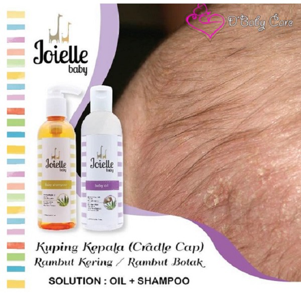 baby oil for cradle cap