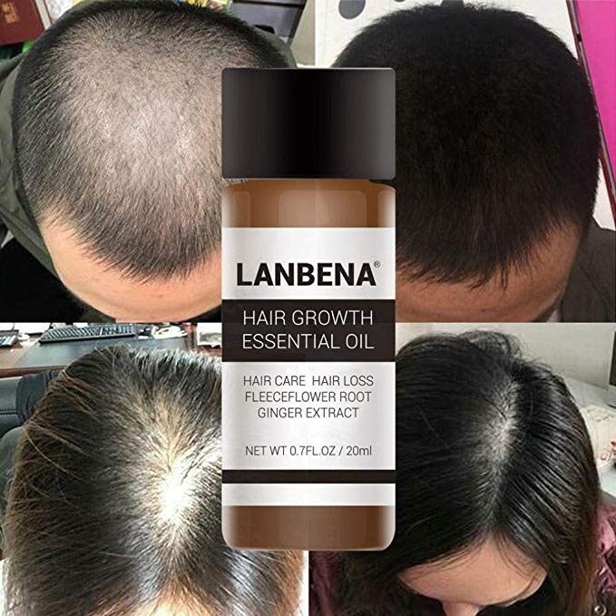20ml Hair Growth Essential Oil Hair Loss Treatment Solution