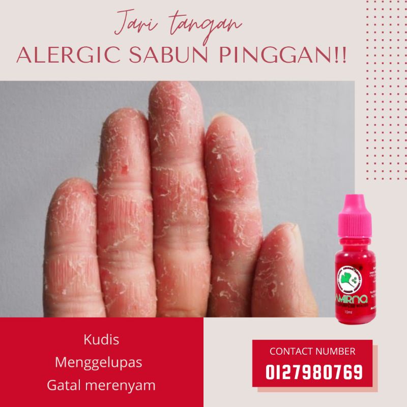 ALERGIC SABUN PINGGAN !! Jari Tangan Luka Gatal Merenyam Air Akar Kayu Amirna