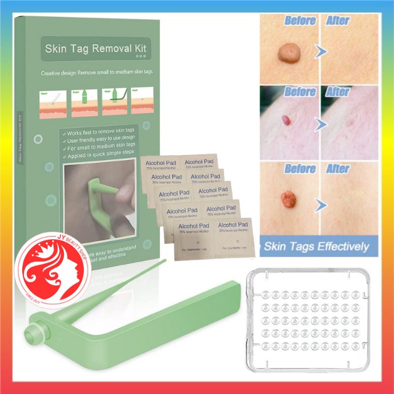 Medical Skin Tag Removal Kit Skin Wart Remover Skin Tag Remover Kit Buang Ketuat Kutil Kulit