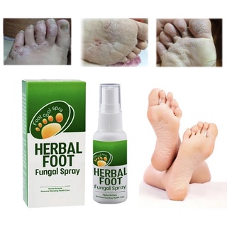 Kaki mengelupas gatal berbau Spray kaki Kulat makan air Foot deodorant ...