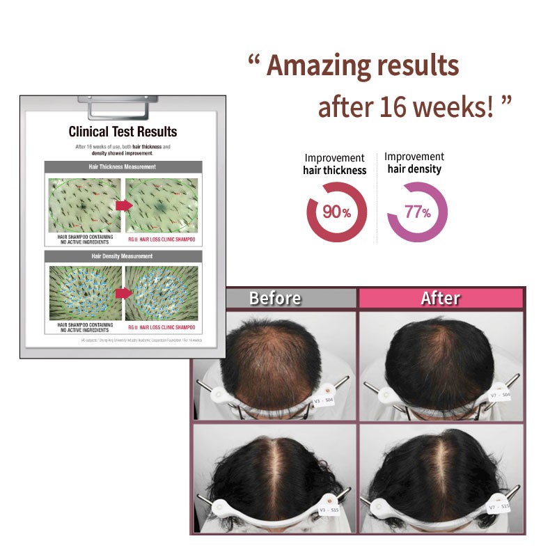 Rg3 Hair Loss Clinic Shampoo 520ml Shopee Malaysia