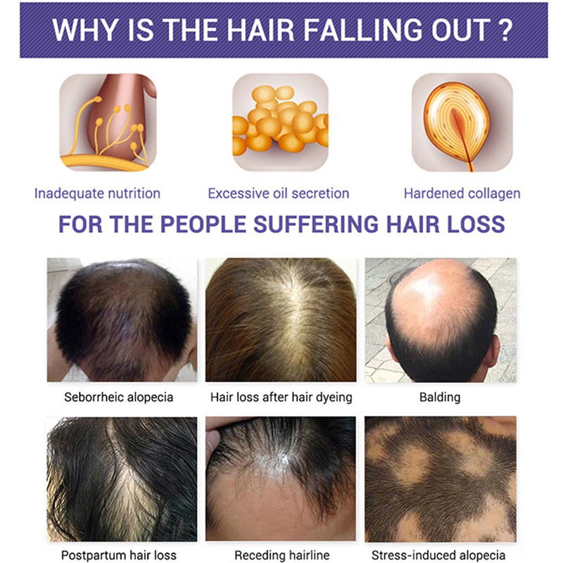 Ginger King Hair Growth Essence Oil Hair Loss Treatment Hair Growth Serum  Hair Care Minyak Rambut For Men & Women 30ml | Shopee Malaysia
