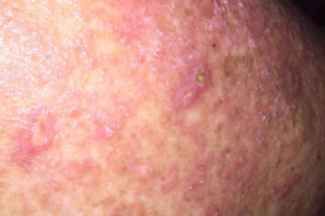 Merawat Kudis Buta Scabies Scaboma Lotion Shopee Malaysia