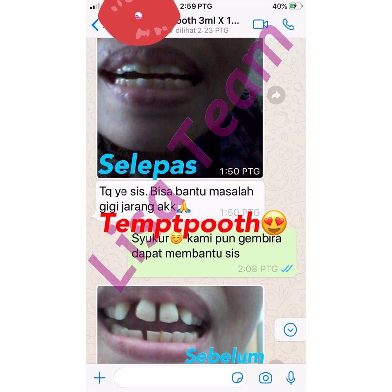 Tempooth Gigi Palsu Gigi Temptooth Gigi Palsu Khas Hilang Satu Batang Gigi 5ml Malaysia