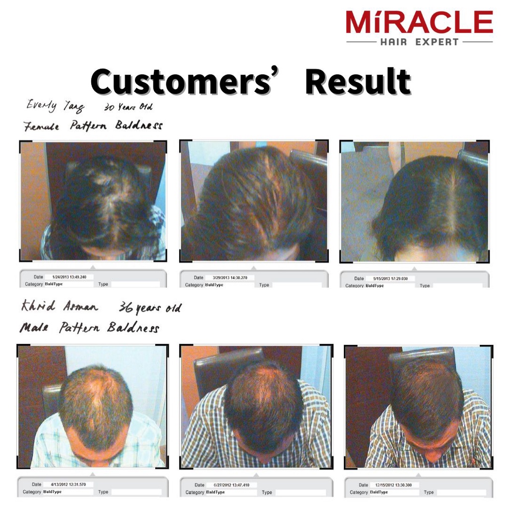 MiracleHairExpert Bio Dual Scalp Shampoo Rambut Gugur Hair Fall Shampoo Hair  Care shampoo (100ml) | Shopee Malaysia