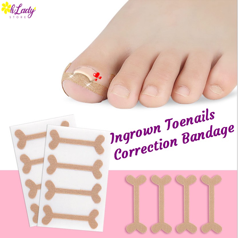 Ingrown Toenails Band Aid Relief Pain Paronychia Correction Pedicure